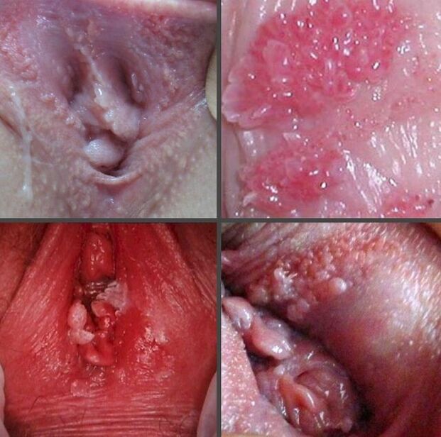 योनि में पेपिलोमा का पास से चित्र