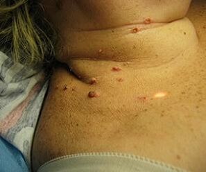 गर्दन पर मानव पेपिलोमावायरस