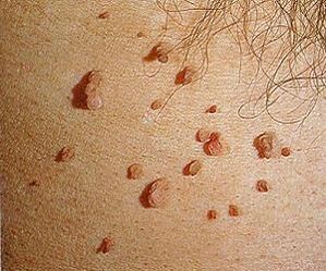 त्वचा पर मानव पेपिलोमावायरस