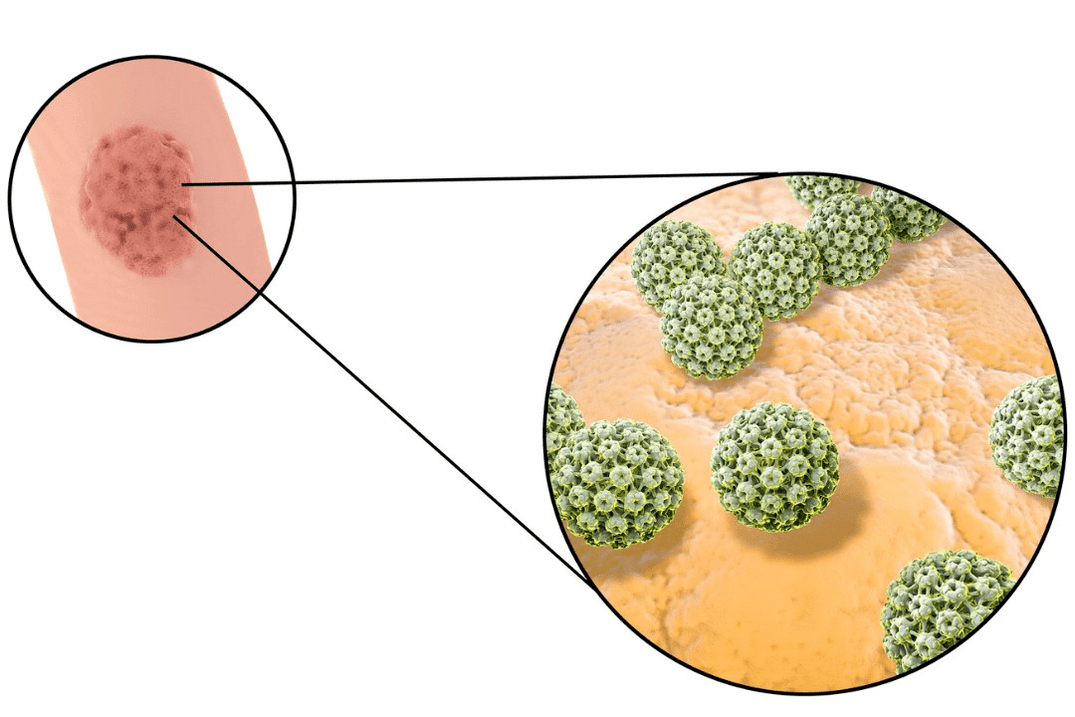 स्क्वैमस सेल पैपिलोमा के साथ संक्रमण का स्रोत